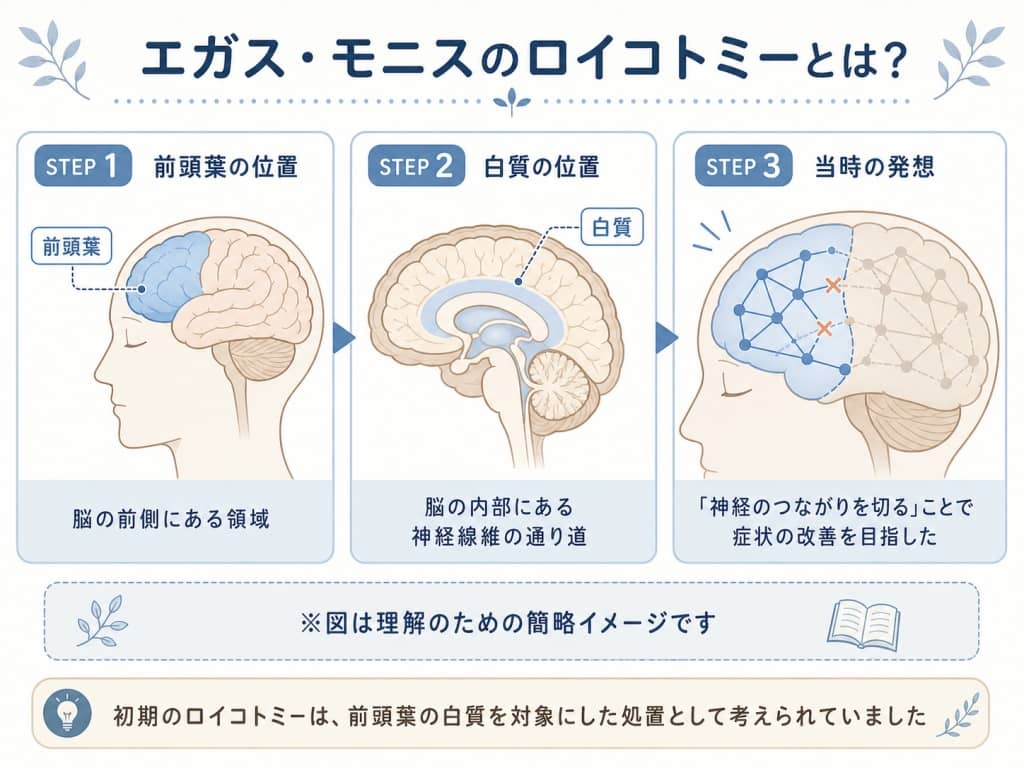 前頭葉の位置と初期のロイコトミーのイメージ図