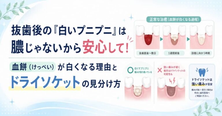抜歯後の「白いプニプニ」は膿じゃないから安心して！血餅(けっぺい)が白くなる理由とドライソケットの見分け方