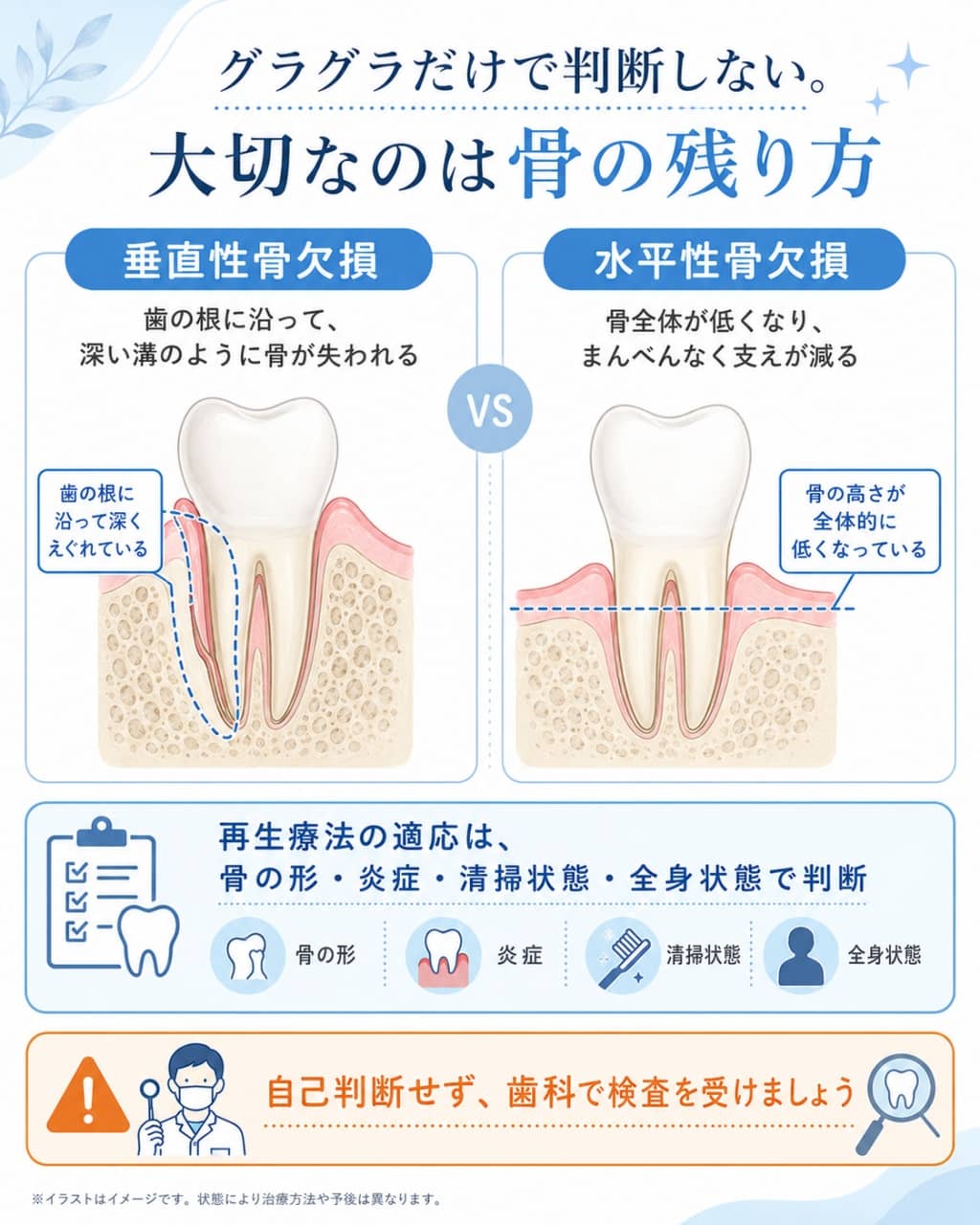 歯周病で歯を残せるかを左右する骨の残り方