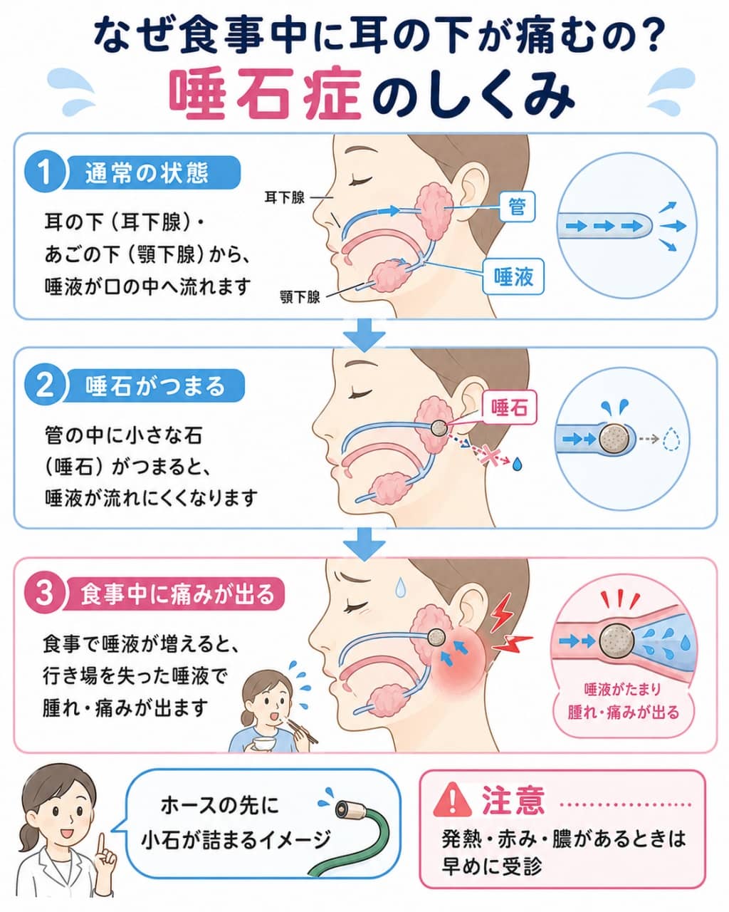食事中に耳の下が痛くなる「唾石症」の仕組み